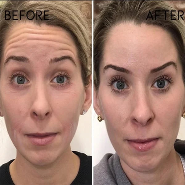 🎉Buy 1 Get 1 Free🎁 - Botox Face Serum